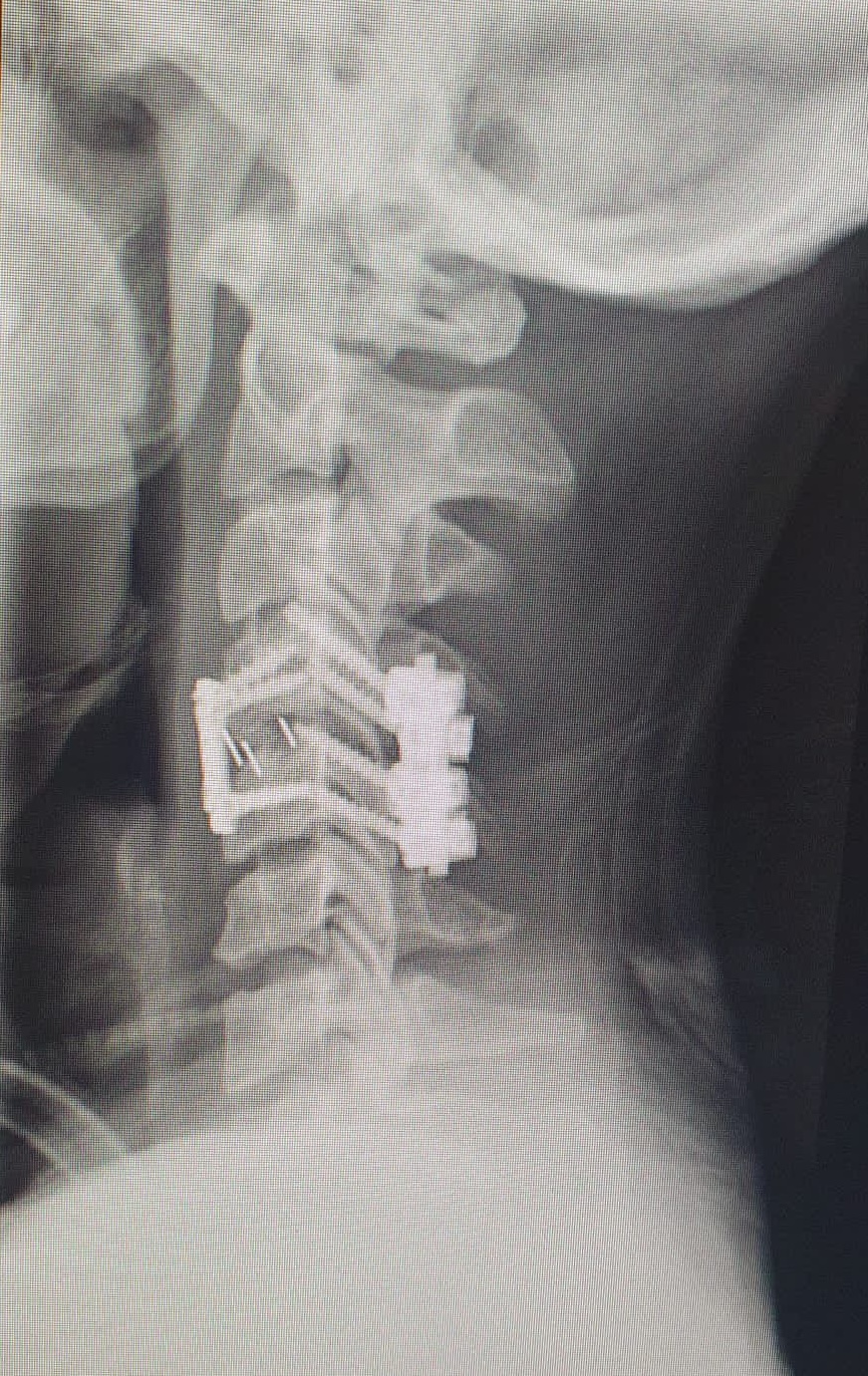 Surgical spinal imaging from Ricky's stabilisation operation